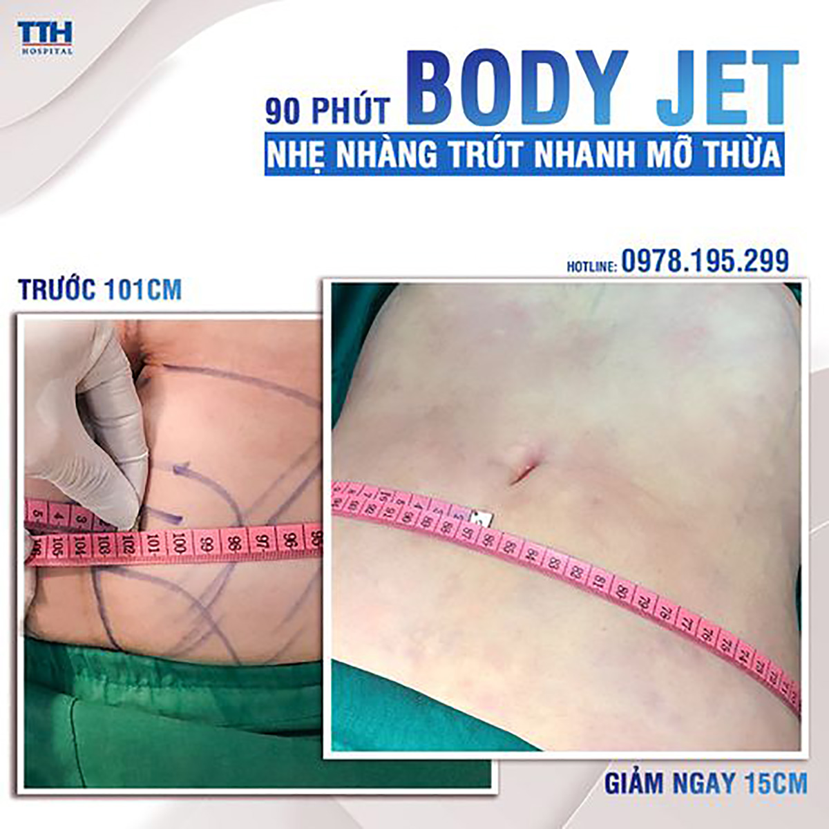 Cấy mỡ Body Jet công nghệ Đức